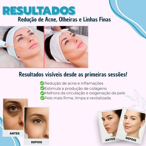 Aparelho Cuphead CH-1265 Estética Alta Frequência Portátil Facial Capilar Limpeza Pele Eletroterapia Skin Care Profissional Anti Rugas